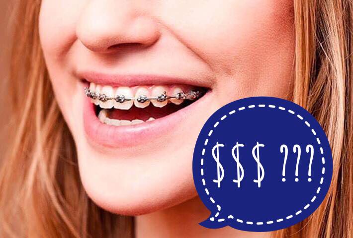 Ціни на брекети